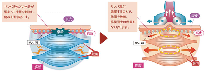 筋膜リリースの効果