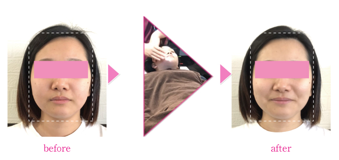 美容鍼、フェイシャル_M様